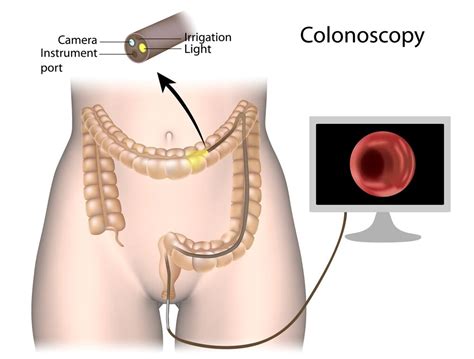 According to the american cancer society, colon cancer is cancer that starts in the colon. Details of Colon Cancer Screening You Should Know