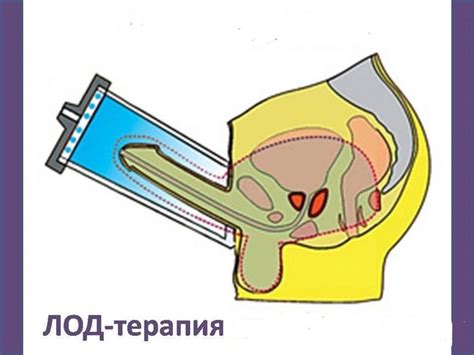 Lodes) — муніципалітет у франції, у регіоні окситанія, департамент верхня гаронна.населення — 280 осіб (2011). ЛОД терапия в урологии: отзывы, видео, аппарат, принцип ...