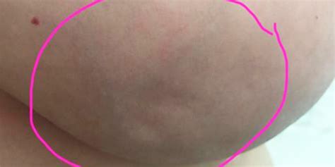 Cancers are quite a lovely sign. This Woman Shared A Picture Of Her Breast So You Can See ...