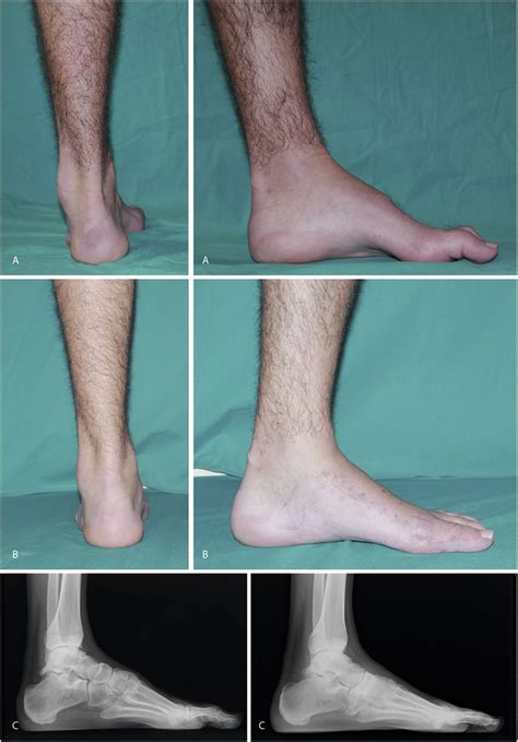 Consult a doctor for medical advice. Charcot-Marie-Tooth disease