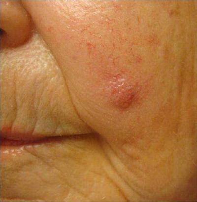 Mccs are dermally based tumors composed of small uniform round blue cells arranged in anastomosing cords, bands and clusters. Cutaneous Malignancies | Plastic Surgery Key