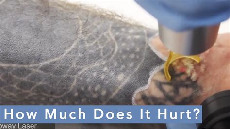 How does laser tattoo removal work? Laser Tattoo Removal PAIN: How Much Does It Hurt? - YouTube