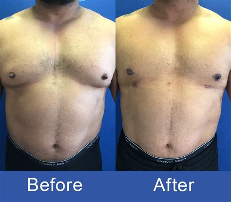 Gynecomastia Surgery Before and After | Los Angeles