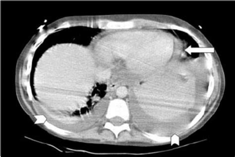 Some cases of the disorder result from common ailments like arthritis, bacterial. Chest CT scan of a patient in our series with bilateral ...