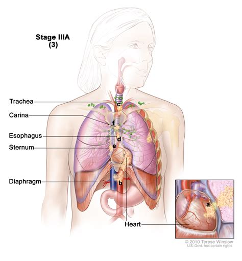 Lung cancer occurs when cells in the lung mutate or change. Non-small Cell Lung Cancer. Causes, symptoms, treatment ...