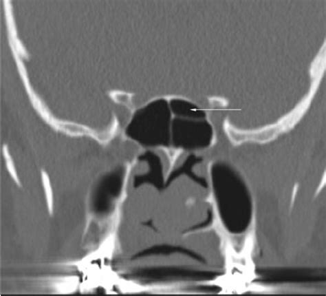 N the aim of imaging the paranasal sinuses. CT scan in coronal plane shows dehiscence of both ...