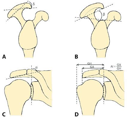 Acromion morphology have been implied to have a major role in shoulder pathology especially caused by affecting subacromial space. Overview of parameters of acromial morphology. A. Acromial ...
