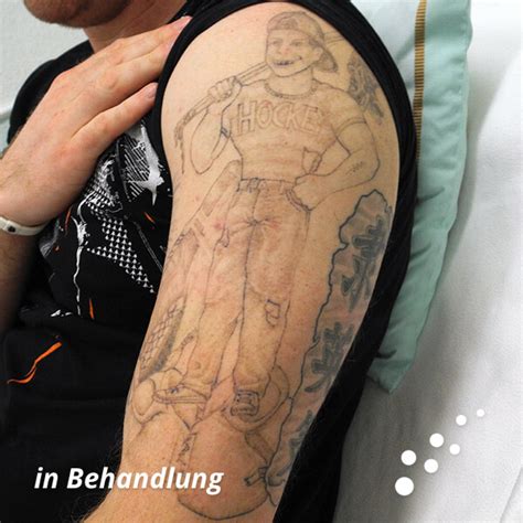 Mirko slomka and jan schlaudraff join the club. ENDLICH OHNE Tattooentfernung - Kosten und Preise