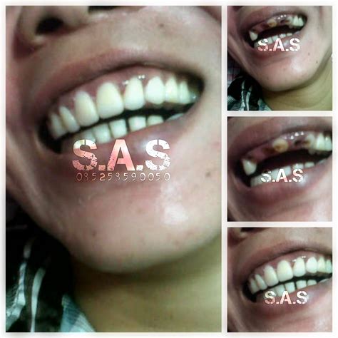 Maybe you would like to learn more about one of these? Koleksi Foto Gigi Palsu Lepas Pasang Sebelum dan ...