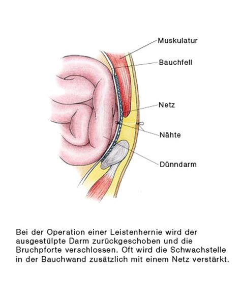 Bereits 48 stunden nach der operation können sie duschen. Leistenbruch | Praxisklinik Marburg