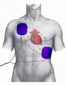 The difference between defibrillation and cardioversion is that the countershock is synchronized to the qrs complex which allows the electric current to be. Uso del defibrillatore: corsi per le società sportive ...