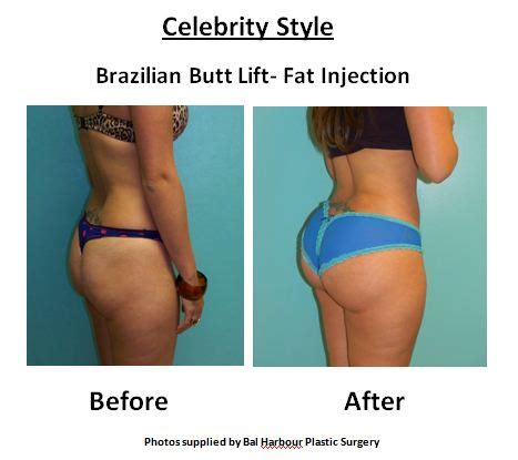 But for some, even the most disciplined workout regimen can't create the significant boost they want. Brazilian buttock lift cost miami, ONETTECHNOLOGIESINDIA.COM