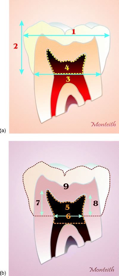 † the sum of the mesiodistal diameters, both right and left, which gives the arch length, is maxillary, 128 mm; 1, mesiodistal crown width; 2, crown height; 3 crown width ...