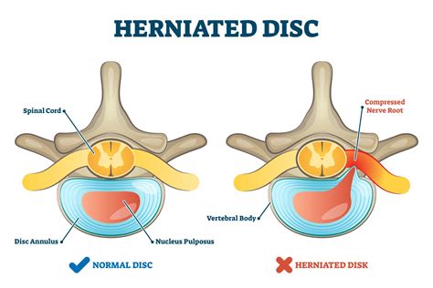 Welcome to comprehensive spine & sports center. Physical Therapist Helps Herniated Disk - Comprehensive ...