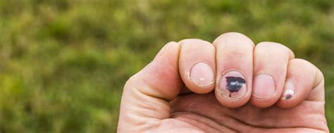 Apabila darah beku berkumpul dengan lebih banyak di bahagian kaki sekiranya masalah ini tidak dikenal pasti dan rawatan diberikan segera, darah beku pada saluran darah kaki ini akan pecah kepada cebisan kecil. Berbagai Gejala dan Cara Mengobati Darah Beku di Kuku ...