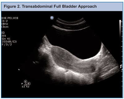 A pelvic ultrasound is a test that uses sound waves to make a picture of the organs and structures in the lower belly (pelvis). Rad Tech CE, ASRT, ARRT® CE, Category A Credits ...