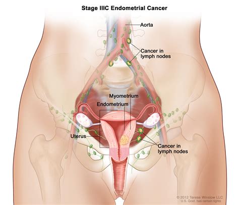 It is so because the symptoms of the cancer are it can be ailments in the form of urinary disorders, constipation, flatulence, feeling of heaviness or abdominal pain, pain in the groin. Endometrial Cancer Treatment (PDQ®)-Patient Version ...