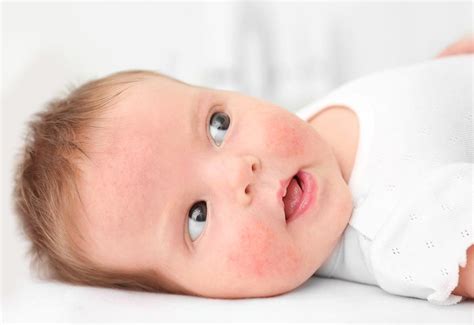 Make sure the water is nice and warm, and then soak your baby for 10 to 15 minutes. A baking soda bath helps to manage baby eczema