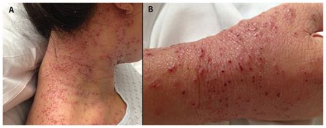 Herpes is an infection that is caused by a herpes simplex virus (hsv). Eczema herpeticum in early pregnancy | CMAJ