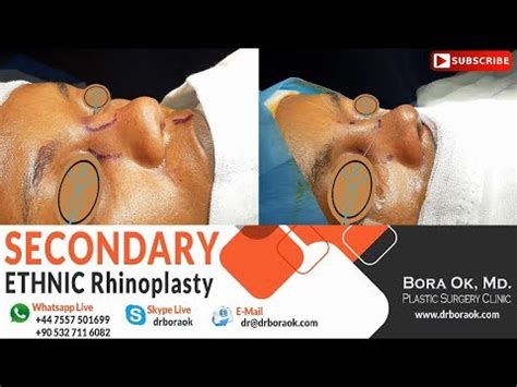 Are you seeking an indian nose job (rhinoplasty)? Dr. Bora Ok, MD. - Open Approach to Secondary Ethnic ...