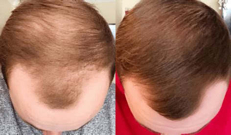 Do keeps hair loss treatments really work? Buy Hair Loss Medication & Treatments Online - Works for 9 ...