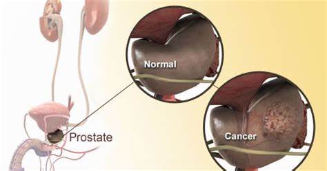 The risk group can help tell if other tests should be done, and what the best treatment options might be. doz ideas: I have Prostate Cancer: Be AWARE of the Disease