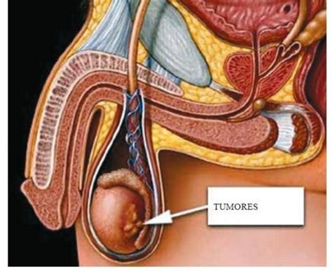 Le mal de dos est une souffrance très largement répandue. Como identificar câncer de testículo em casa - Sexualidade ...
