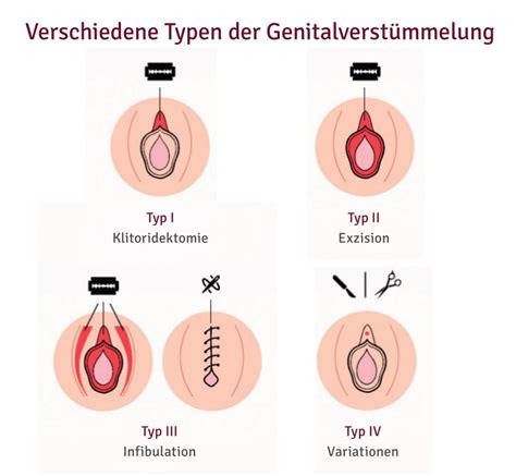 Das vorkommen ist von land zu land, manchmal sogar innerhalb eines landes, sehr unterschiedlich, in einigen ländern ist nur ein kleinerer prozentsatz der 8. Praktik | Genitalverstümmelung | Arbeitsfelder