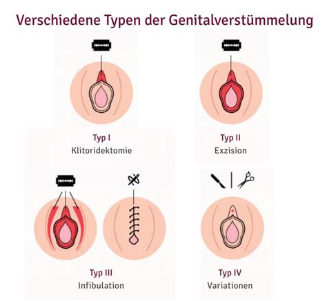 Female genitale mutilation (fgm) ist für mich ein schreckliches verbrechen und überhaupt nicht schönzureden. Praktik | Genitalverstümmelung | Arbeitsfelder