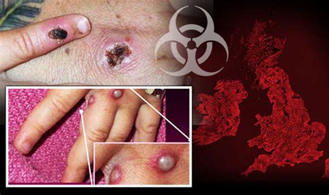 Matt hancock told mps that two cases of monkeypox have spotted in uk. Monkeypox: THIRD case of the rare disease confirmed in England - Symptoms to watch out for ...