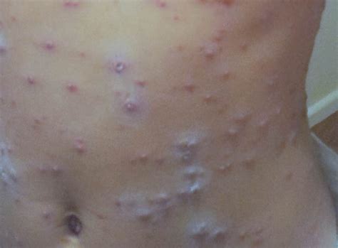 After dealing with the chickenpox as a child, they typically never come back. Chicken pox pics | Symptoms and pictures