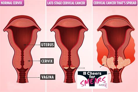 Urinary obstruction and bleeding are common signs. The 5 early signs you could have 'silent killer' cervical ...