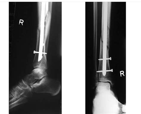 Tulang kaki ngilu saat malam. Beredar Foto Rossi Pasca Operasi, Foto X-Ray Tampak ...