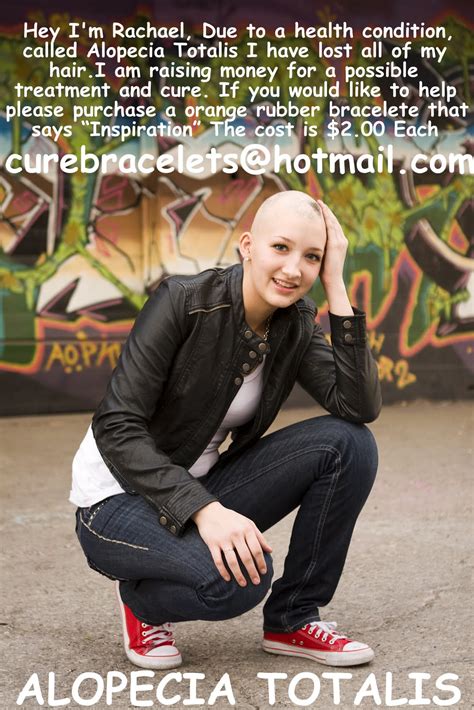 The complete and usually sudden loss of hair from the scalp. Rachael Michelle: Alopecia Fundraiser