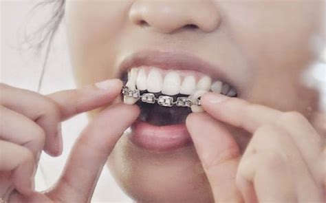 Maksudnya di sini adalah jenis braces yang pesakit gunakan. Boleh Kena HIV Pakai 'Fake Braces' - M-Update