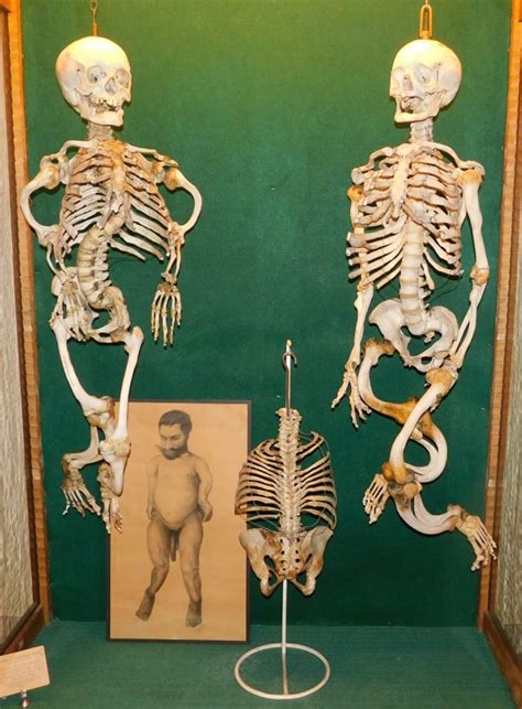Anatomie humaine normale et pathologique - Musée Testut ...