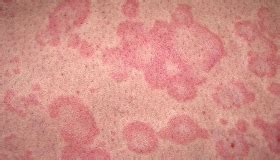 A csalánkiütés (urticaria) a bőr felsőbb rétegeinek duzzanatával járó tünetegyüttes. Csalánkiütés - Csalánkiütés kezelése - Belvárosi Orvosi ...