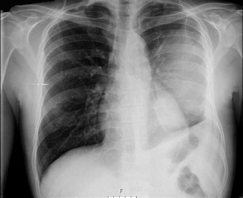 It allows pleural debridement with the subsequent lung reexpansion, pus evacuation and drainage placement. Fusobacterium Nucleatum Empyema: An Atypical Presentation