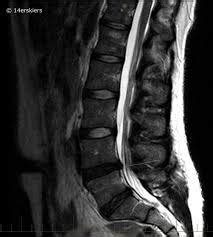 The altered shape occurs when the disc's soft inner material (nucleus pulposus). Rawatan Slip Disc Kesan Serta-merta Shah Alam dan JB