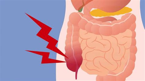 Oftentimes, a recurrence and a metastasis are synonymous, says dean g. Colon Cancer Symptoms: What to look for