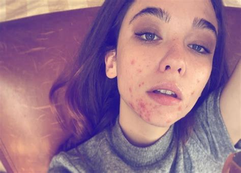 Matilde gioli, matilda de angelis. Star senza trucco: Matilda De Angelis mostra l'acne sul viso