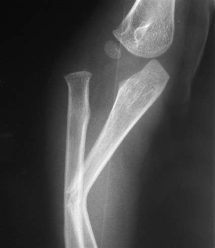 Monteggia Fracture - Pediatric - Pediatrics - Orthobullets