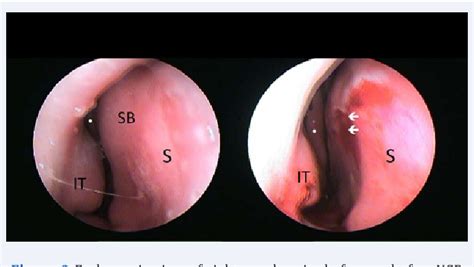 Find out about nasal polyps, which are painless soft growths inside your nose. Figure 2 from RadioFrequency Ablation of Septal Swell Body ...