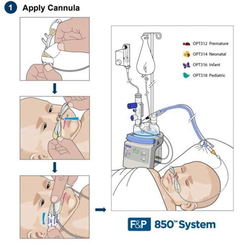 Able to deliver adequately heated and humidified medical gas at flows up to 60 l/min, it is considered to have a number of physiological advantages. Fisher & Paykel OPT312 - CANNULA, OPTIFLOW, JUNIOR ...