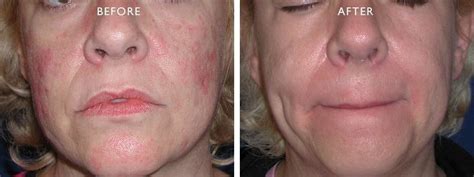 Maybe you would like to learn more about one of these? V-Beam LASER Patient Before and After Gallery - Advanced ...