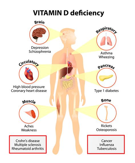 But those who may be at risk for deficiency should consider having their levels. Vitamin D deficiency after a catastrophic injury ...
