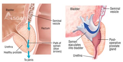 Retrograde — ghostemane ☿ 02:04. Retrograde Ejaculation or Dry Orgasm Treatment | ASGAR GROUP®