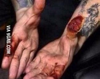 Both suffered second and third degree burns and received skin grafts. Nick Augusto from Trivium - for all those who loved Travis ...