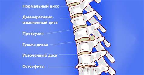 Диета при хиатальной грыже