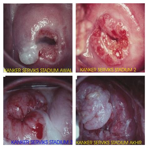 Kanker serviks adalah penyakit akibat tumor ganas pada daerah mulut. Mengerikan... Takhanya Lewat Hubungan Intim, TANGAN JUGA ...